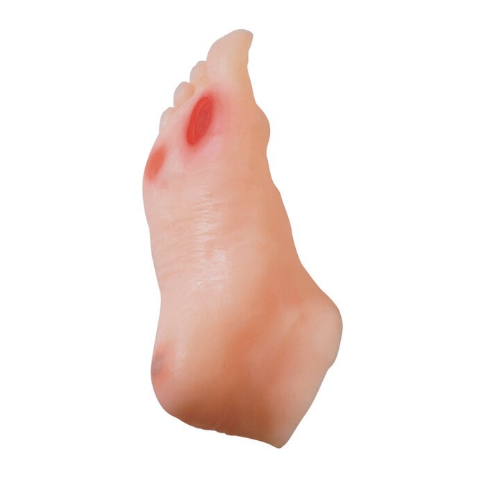 diabetic foot model, appearance of 3 ulcers, cracked skin, diabetic neuropathy, realistic look and feel, Health Edco, 26101