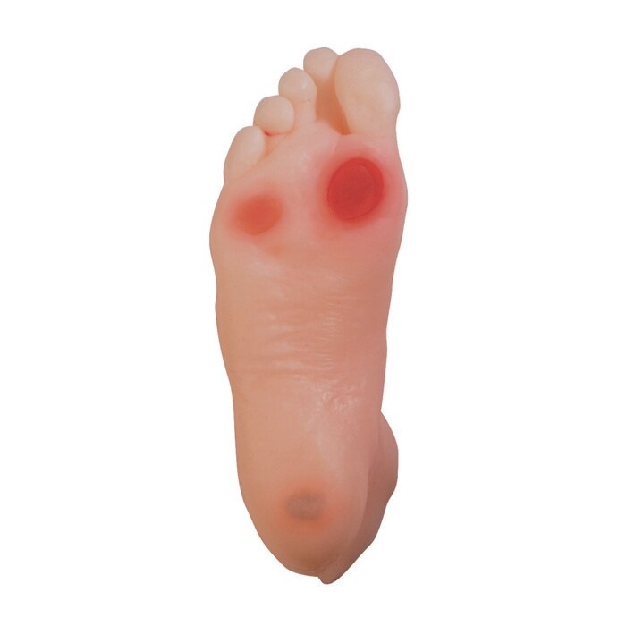 diabetic foot model, appearance of 3 ulcers, cracked skin, diabetic neuropathy, realistic look and feel, Health Edco, 26101