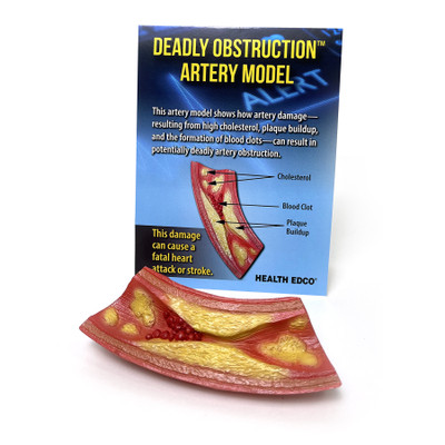 Deadly Obstruction Artery Model, health education anatomical artery model with informational tent card, Health Edco, 26989
