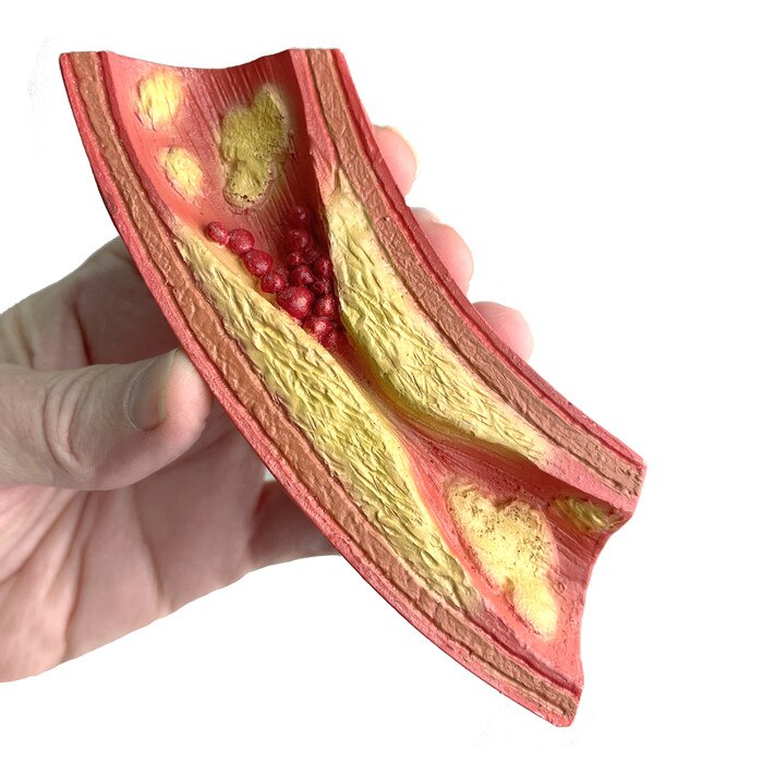 Deadly Obstruction Artery Model, health education anatomical artery model showing atherosclerosis, Health Edco, 26989