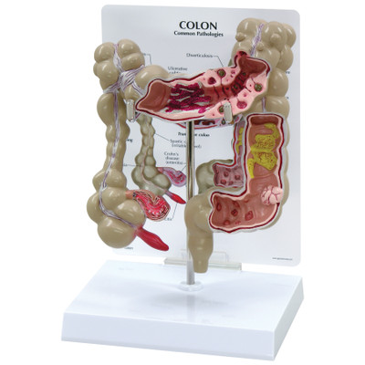 Colon Model 3D with conditions noted on background card, cutaway on model shows conditions, Health Edco, 52310