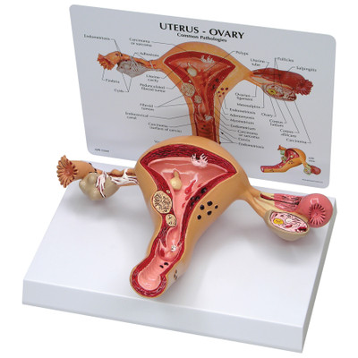 Uterus Ovary 3D cutaway model with standup card showing common conditions, Health Edco, 52409