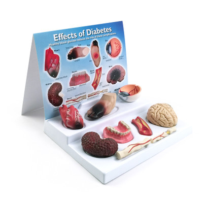 Effects of Diabetes Display for health education from Health Edco with organ models of uncontrolled diabetes effects, 78792