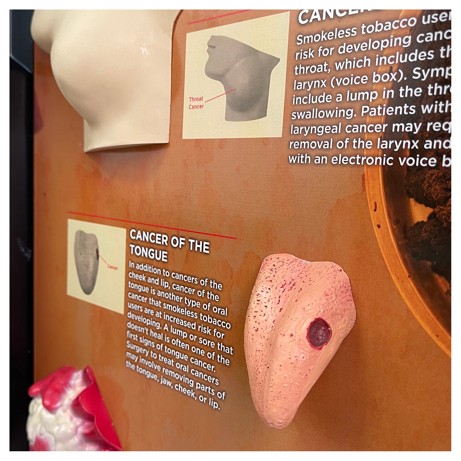 Throat Cancer From Chewing Tobacco