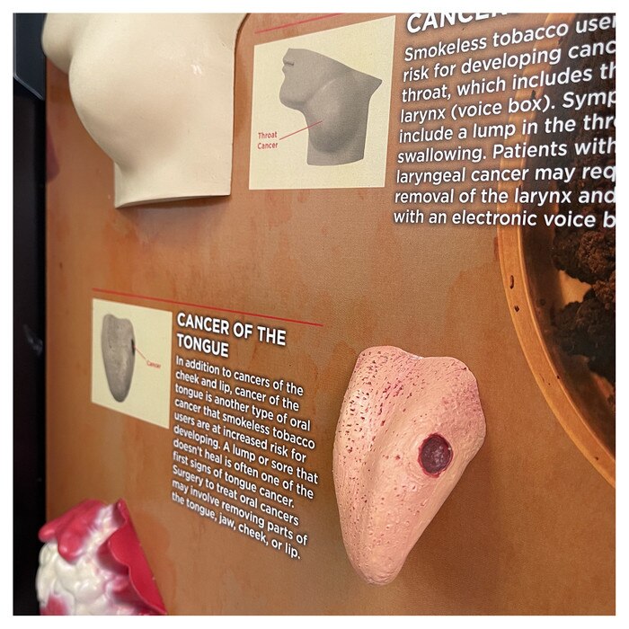 Smokeless Tobacco Consequences 3-D Display, closeup of health education display of tongue cancer model, Health Edco, 78817