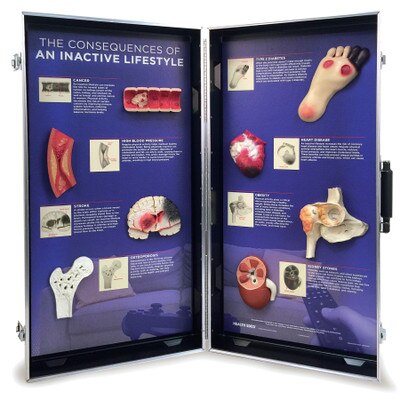 Inactive Lifestyle Consequences 3-D Display by Health Edco, models of diseased organs caused by sedentary lifestyle, 78854