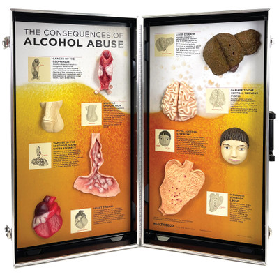 Alcohol Abuse Consequences 3-D Display, health education display of physical effects of alcohol abuse, Health Edco, 78879