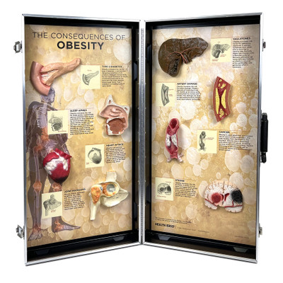 Obesity Consequences 3-D Display, health education display with models of internal organ obesity damage, Health Edco, 78880
