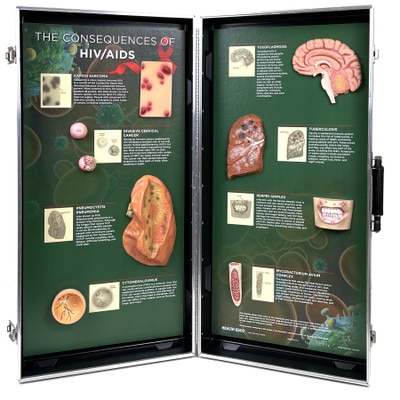 HIV/AIDS Consequences 3-D Display for health education by Health Edco with models of AIDS opportunistic infections, 78882