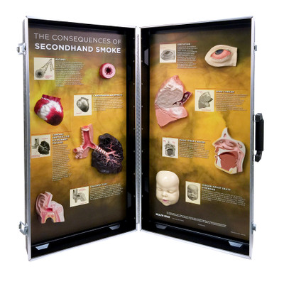 Secondhand Smoke Consequences 3-D Display for health education by Health Edco with models of smoke-damaged organs, 78925