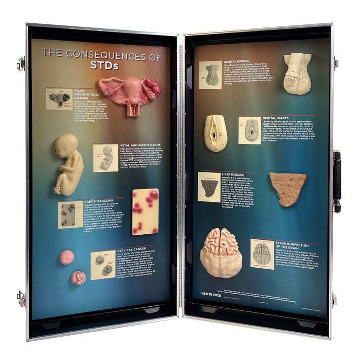 STDs Consequences 3-D Display, health education display showing effects of sexually transmitted diseases, Health Edco, 78926
