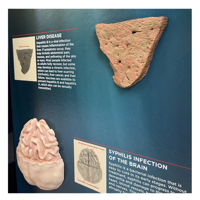 STDs Consequences 3-D Display, models of liver disease and syphilis of the brain in health teaching tool, Health Edco, 78926