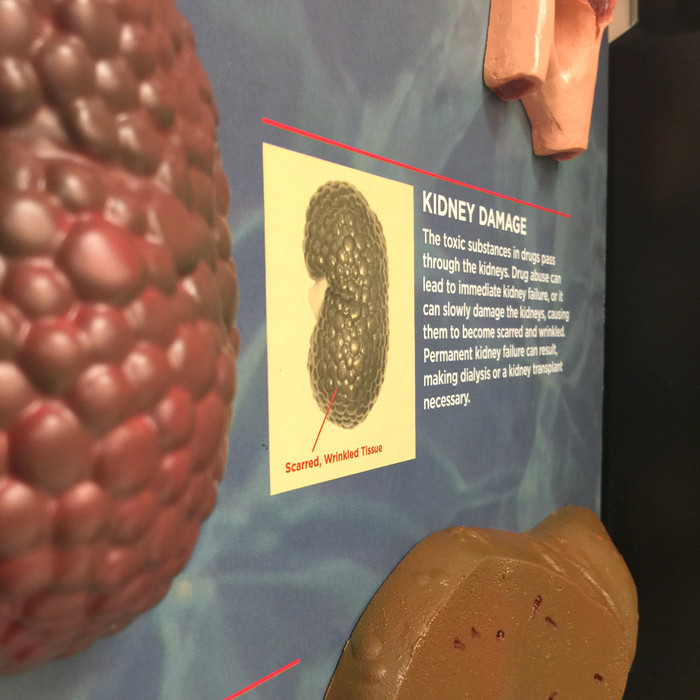 Drug Abuse Consequences 3-D Display from Health Edco, close-up image of 3-D kidney model showing drug-related damage, 78928