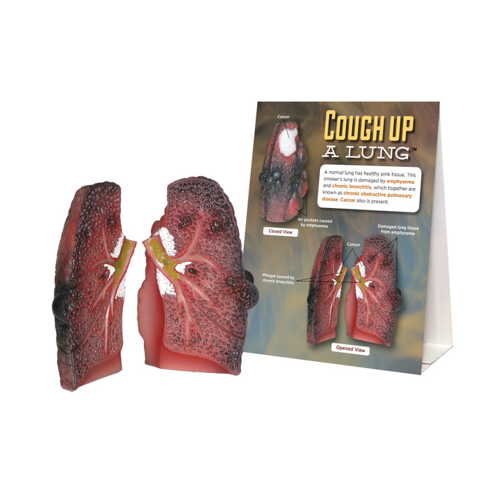 Cough Up a Lung Model for health education from Health Edco showing a smoker's lung with lung cancer and COPD, 78958
