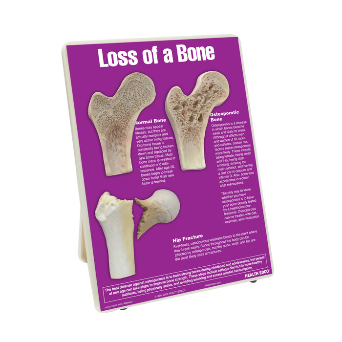 Loss of a Bone Easel Display, health education display showing effects of osteoporosis with bone models, Health Edco, 79143
