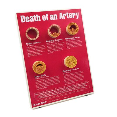 Death of an Artery Easel Display for heart health education by Health Edco with artery models depicting plaque buildup, 79149