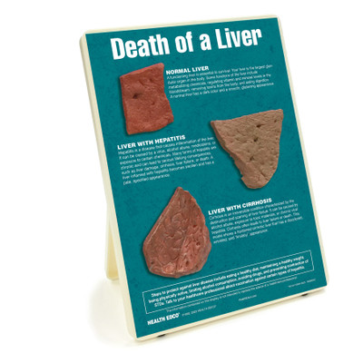 Death of a Liver Easel Display, health education display with liver models showing liver damage, Health Edco, 79150