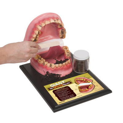 Giant Mr. Gross Mouth Model, health education mouth model with dental harms from smokeless tobacco use, Health Edco, 79159