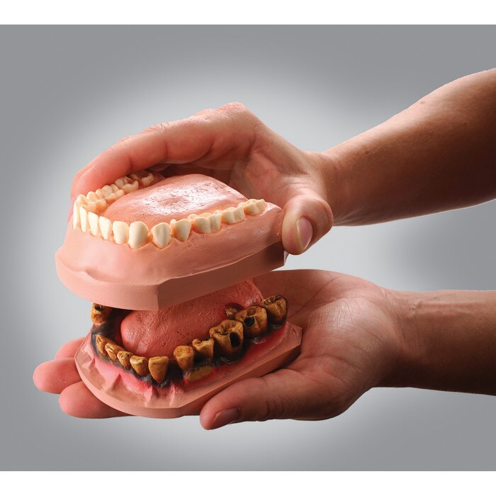 Dip N Decay Model Set, interactive tobacco education tool, healthy teeth model and tobacco teeth model, Health Edco, 79166