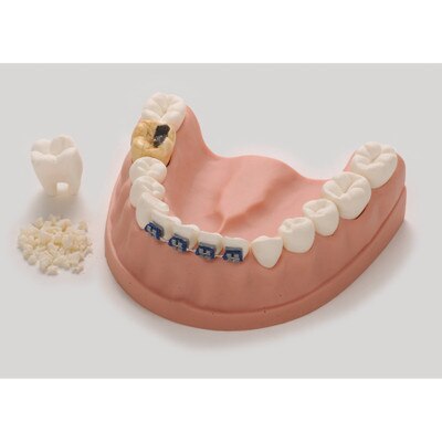 Dental Health Model, dental education model of lower jaw with teeth, braces, cavity, and simulated plaque, Health Edco, 79229