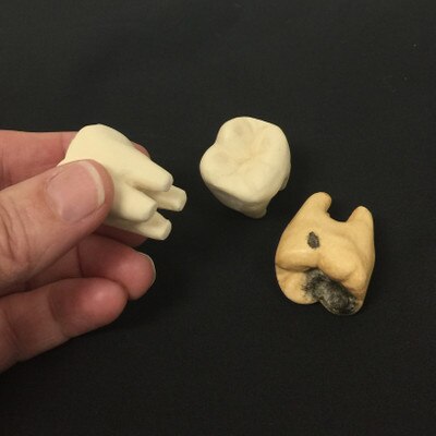 Dental Health Model Replacement Teeth with two healthy molar models and one decayed molar model, Health Edco, 79587