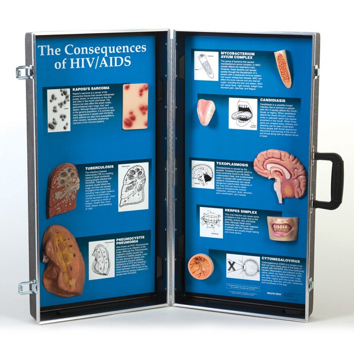 The Consequences Of HIV/AIDS 3D Display Health Edco