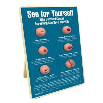 See for Yourself: Pap Tests Easel Display, women's health education display showing cervical cancer stages, Health Edco, 79733