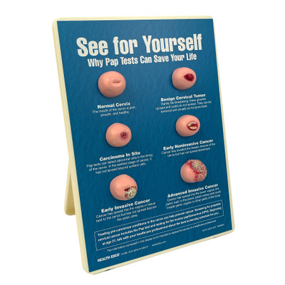 See for Yourself: Pap Tests Easel Display, women's health education display showing cervical cancer stages, Health Edco, 79733