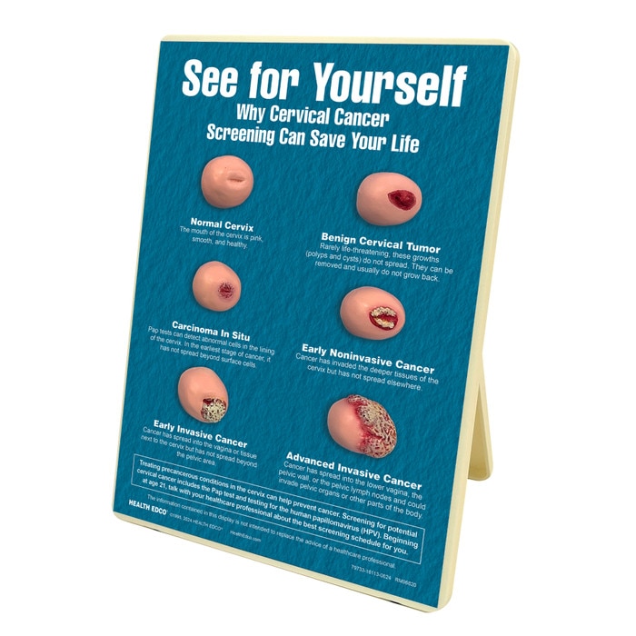 See for Yourself: Pap Tests Easel Display, women's health education display with cervix models side view, Health Edco, 79733