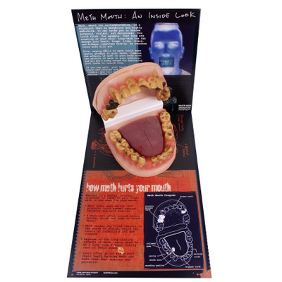 Meth Mouth: An Inside Look Display for health education by Health Edco, mouth model showing oral damage of meth abuse, 79758