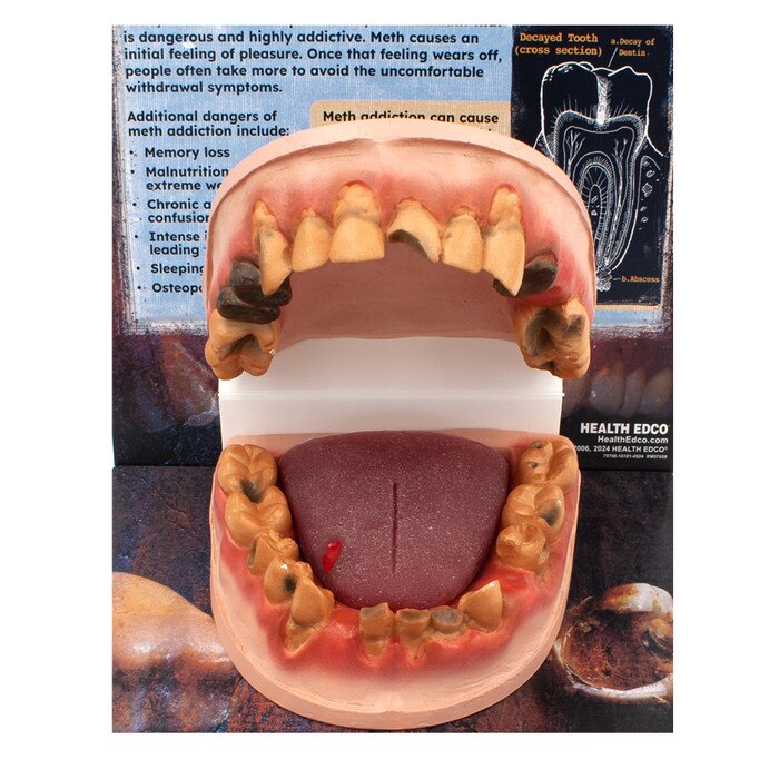Meth Mouth: An Inside Look Display for health education by Health Edco, mouth model showing oral damage of meth abuse, 79758