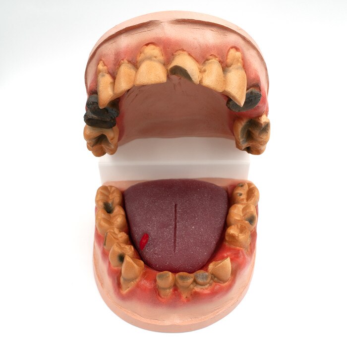 Meth Mouth: An Inside Look Display for health education by Health Edco, mouth model showing oral damage of meth abuse, 79758