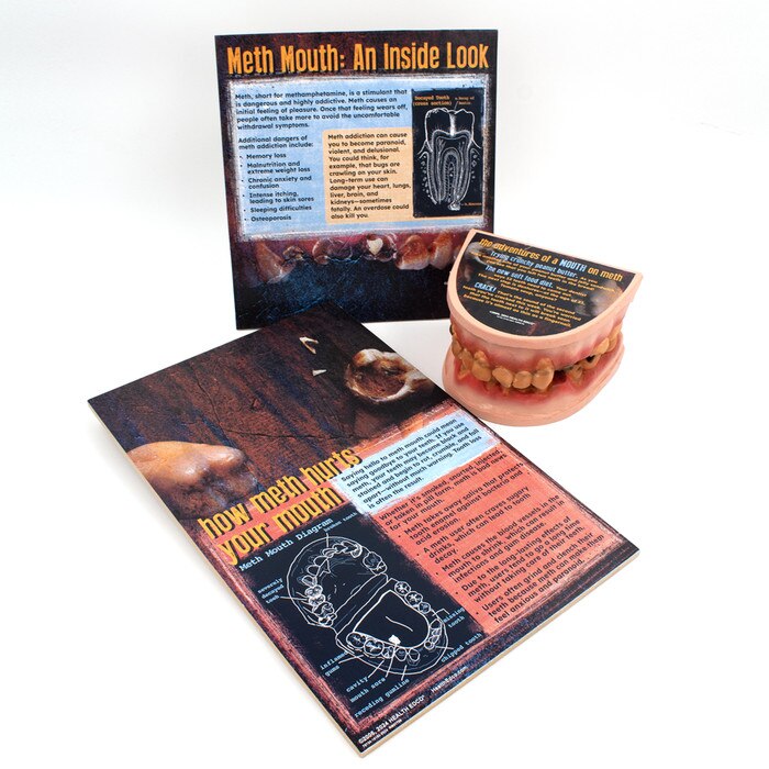 Meth Mouth: An Inside Look Display for health education by Health Edco, mouth model showing oral damage of meth abuse, 79758
