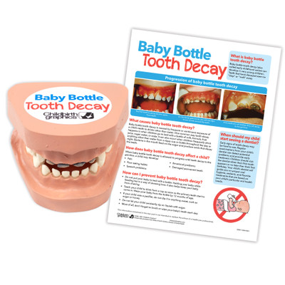 Baby Bottle Tooth Decay Model, dental model cast from a child with rotted teeth and dental decay, Childbirht Graphics, 79865