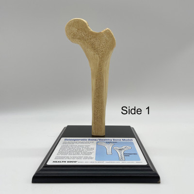 Osteoporotic Bone / Healthy Bone Model, Health Edco health education anatomy model, healthy and unhealthy bone model, 84070