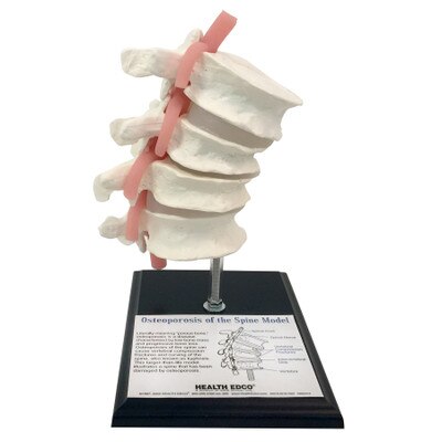 Osteoporosis of the Spine Model, vertebrae model on stand with diagrammed parts label, Health Edco, 84078