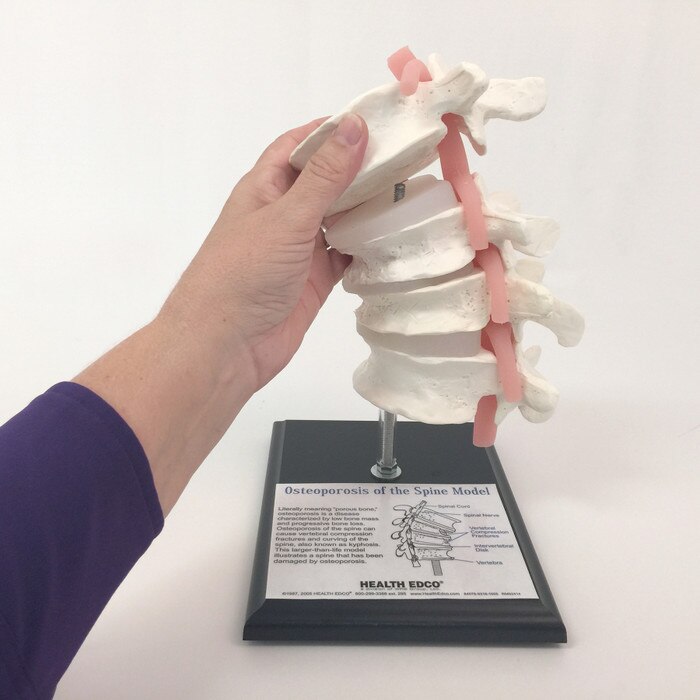 Osteoporosis of the Spine Model, vertebrae model on stand hand removing parts diagrammed label, Health Edco, 84078