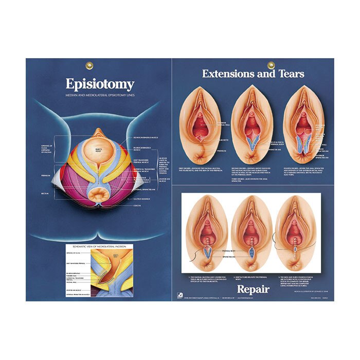 Educational Episiotomy Paper Chart Childbirth Graphics