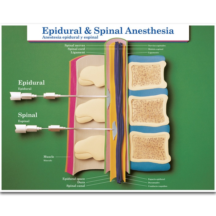 Epidural & Spinal Anesthesia Chart | Childbirth Graphics