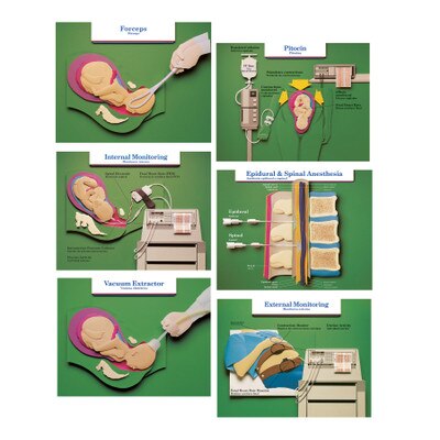 Labor and Birth Intervention Chart Set, six childbirth education charts with a paper art 3D look, Childbirth Graphics, 90615