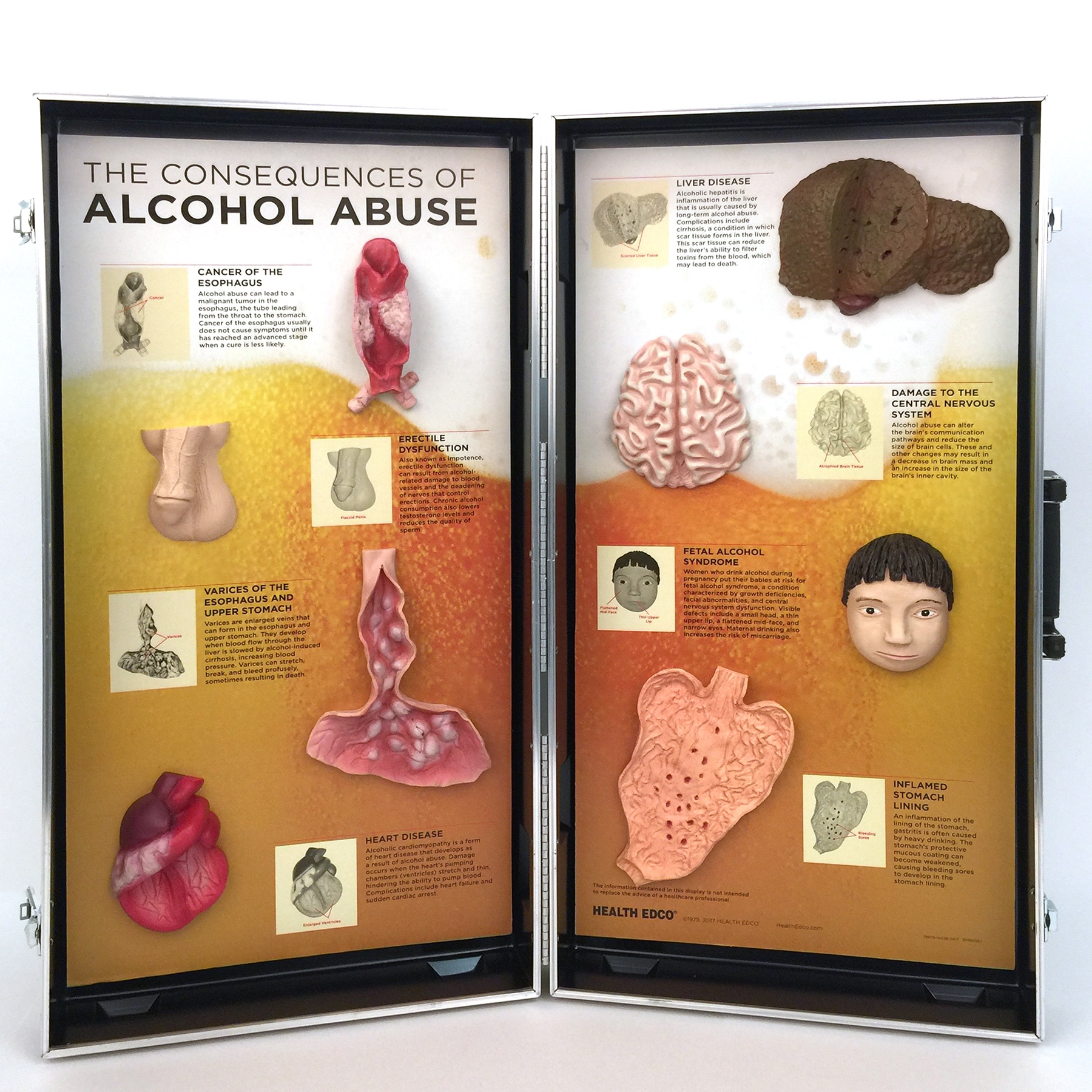 Alcohol Abuse Consequences Display with 3-D organ models