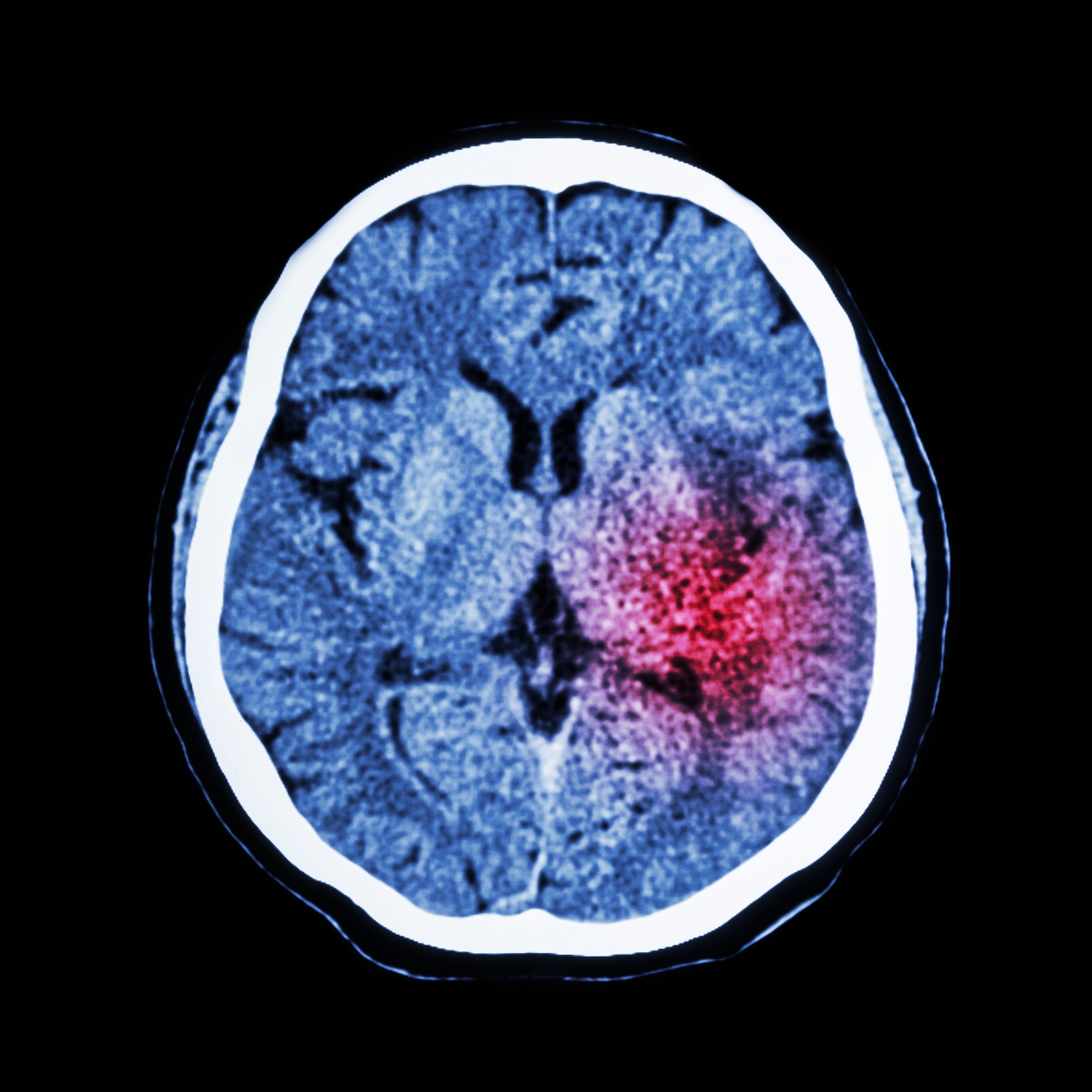 CT scan of brain with stroke damage