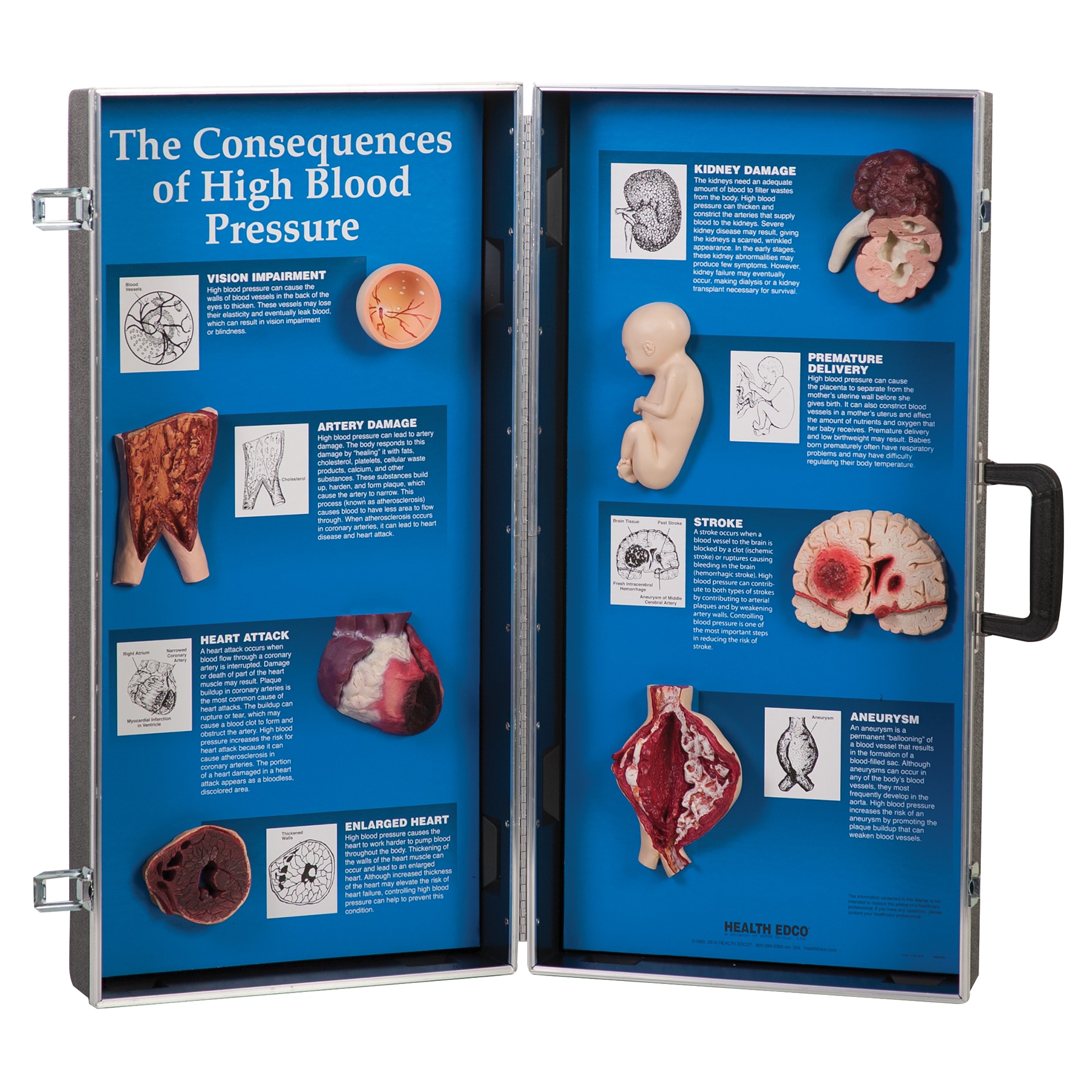 Consequences of High Blood Pressure 3-D Display from Health Edco