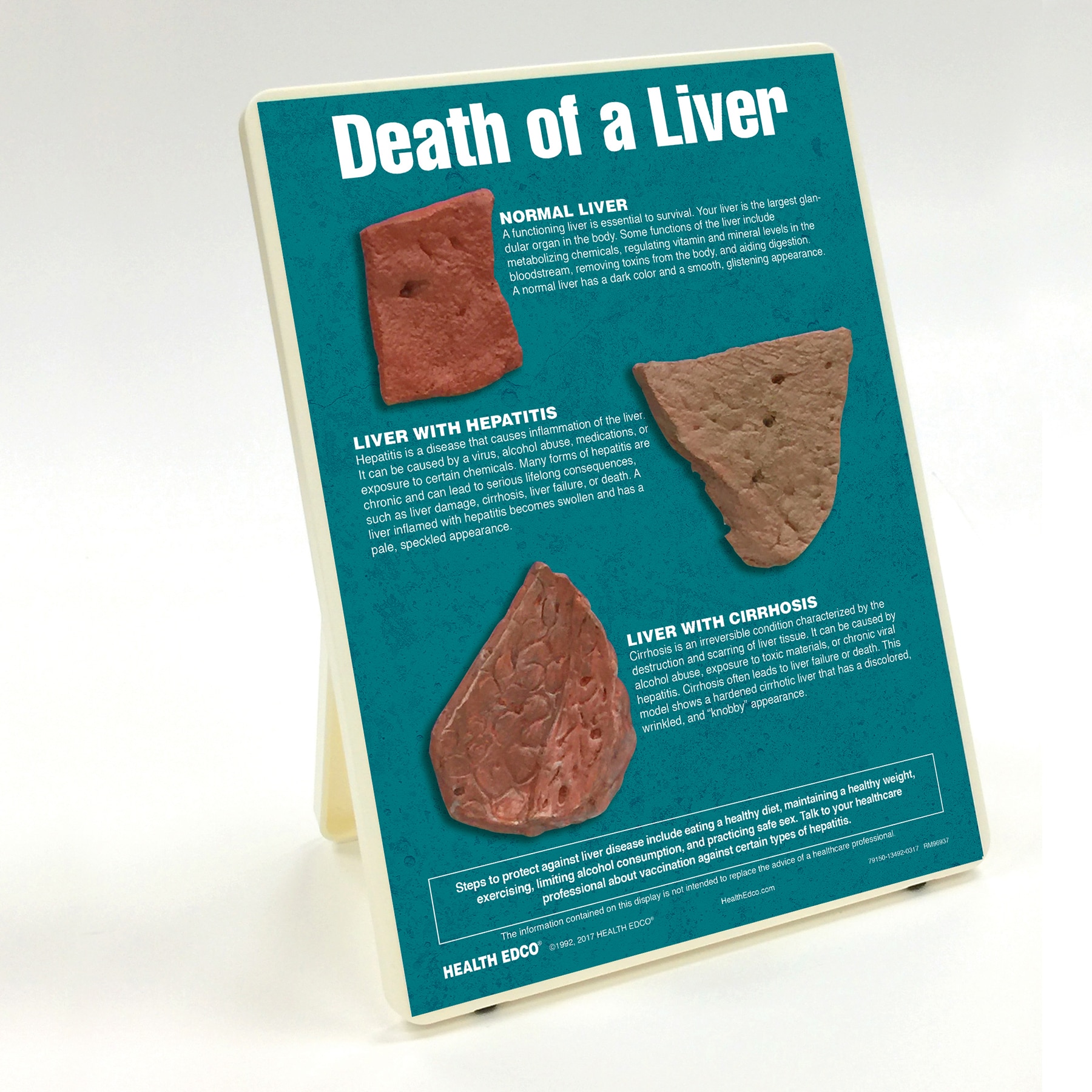 Death of a Liver Easel Display with models of a healthy, hepatic, and cirrhotic liver