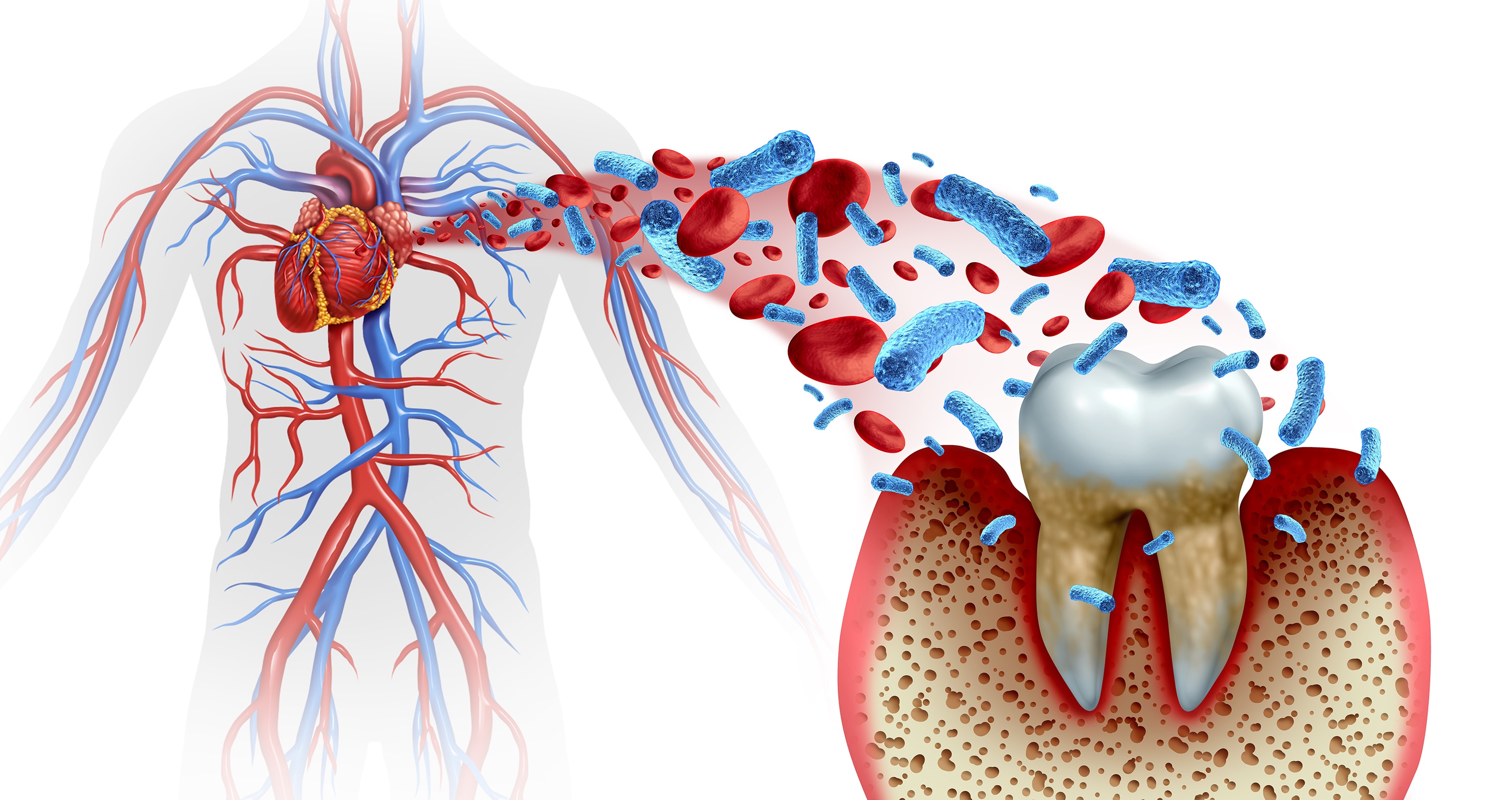 anatomical graphic showing link between oral bacteria and heart health