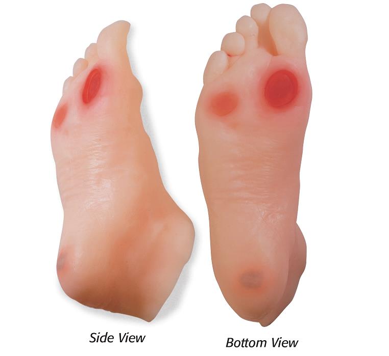 Diabetic Foot Model from Health Edco with realistic detail of diabetic foot ulcers