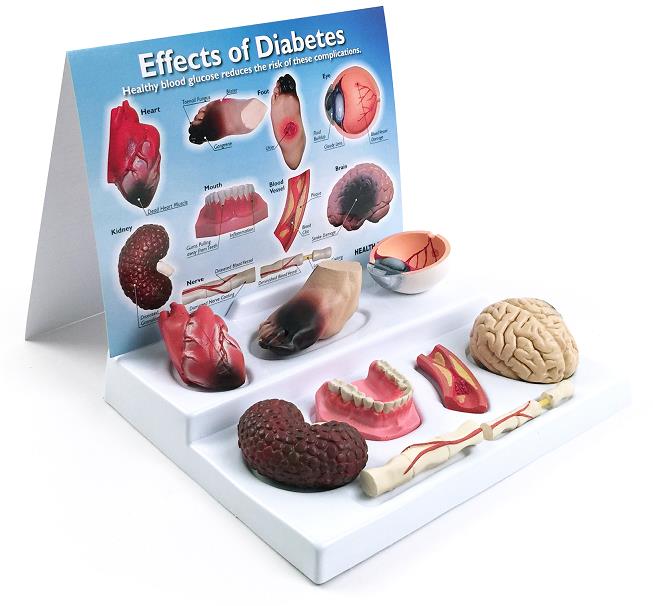 Effects of Diabetes Display from Health Edco