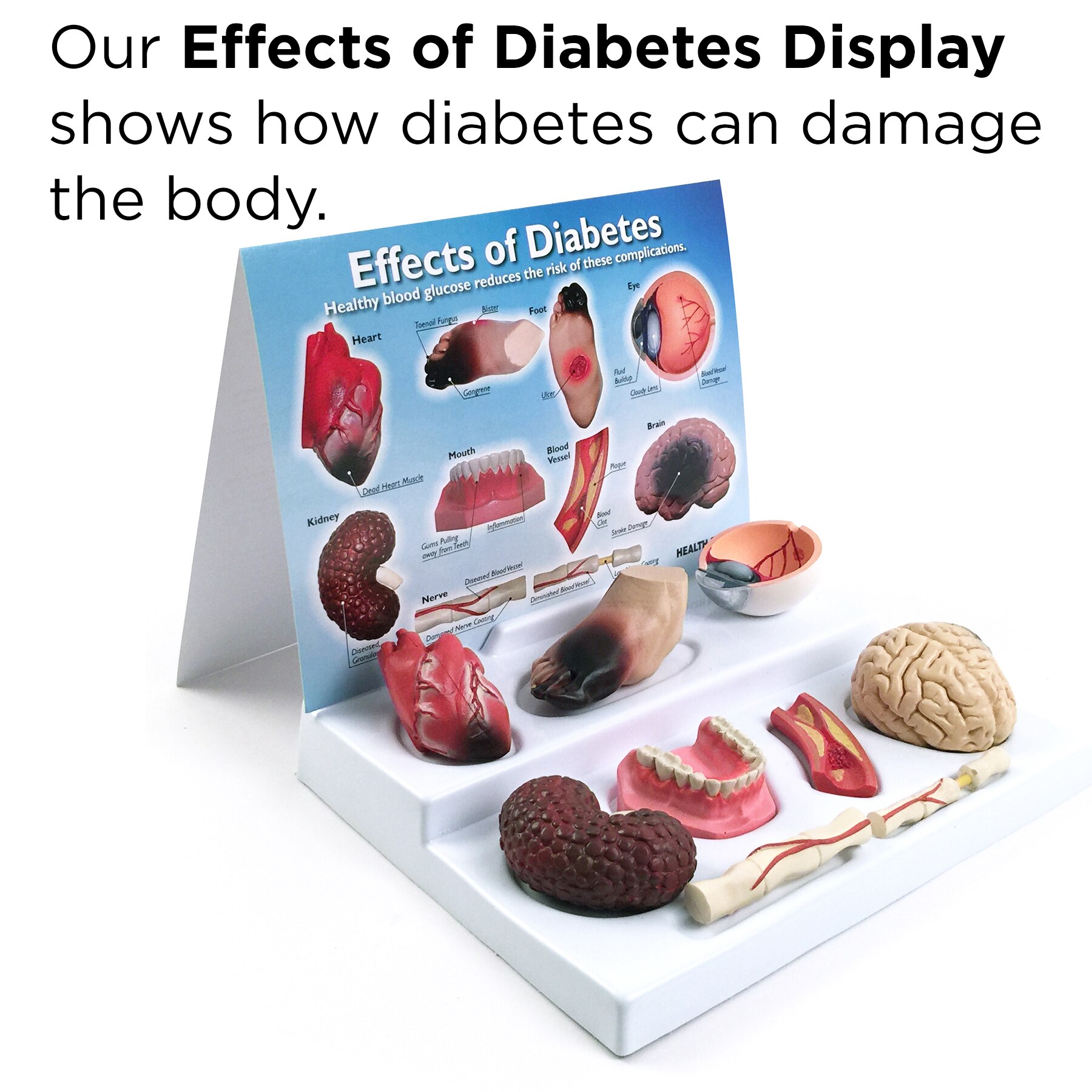 Effects of Diabetes Display for health education from Health Edco, 78792