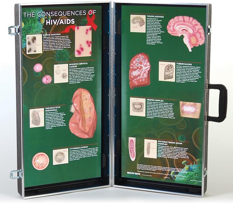 The Consequences of HIV/AIDS 3-D Display for health education from Health Edco